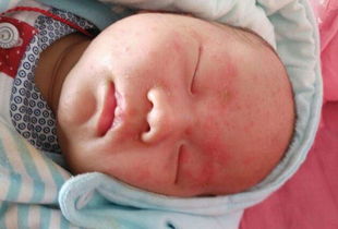 婴儿湿疹护理建议